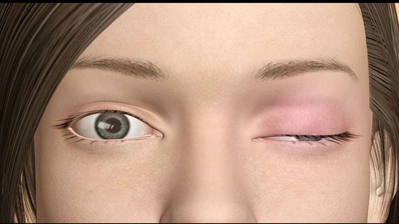 میاستنی گراویس