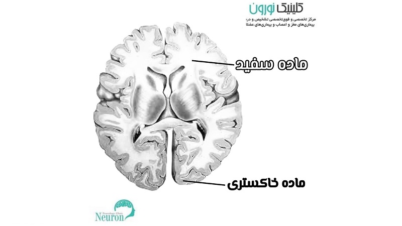 قسمت سفید و خاکستری مغز | کلینیک مغز و اعصاب اصفهان