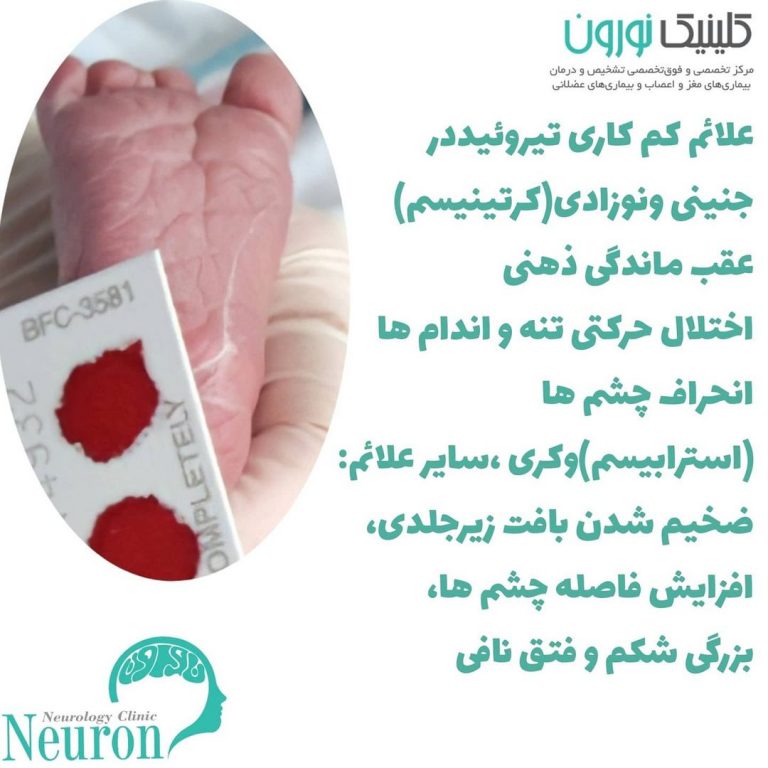 کم کاری تیروئید با مغز و سیستم عصبی چه میکند؟