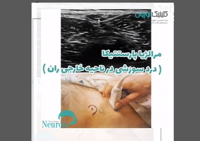 مرالژیا پارستتیکا