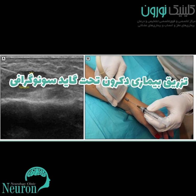 بیماری دکرون ( تنوسینوویت دکرون )