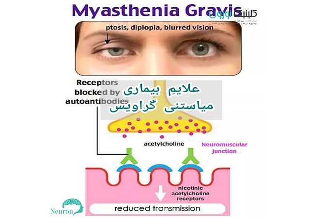 علائم بیماری میاستنی گراویس