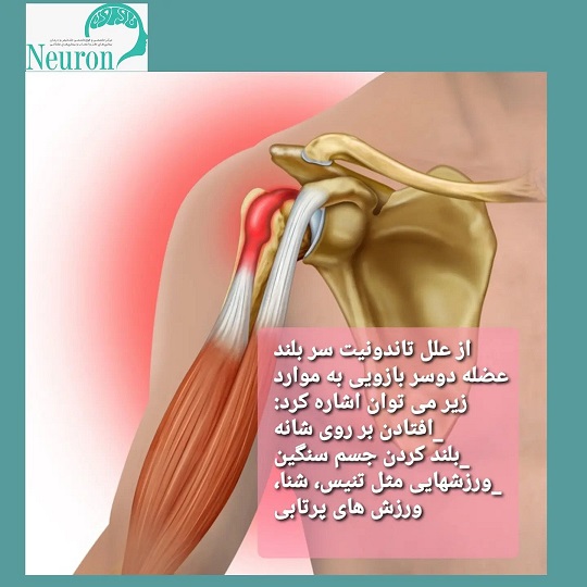 تاندونیت عضله دوسربازویی