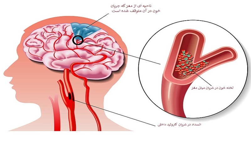 علل و علائم سکته مغزی در جوانان و کودکان