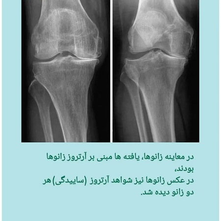 درد زانو با معرفی یک بیمار | کلینیک مغز و اعصاب اصفهان
