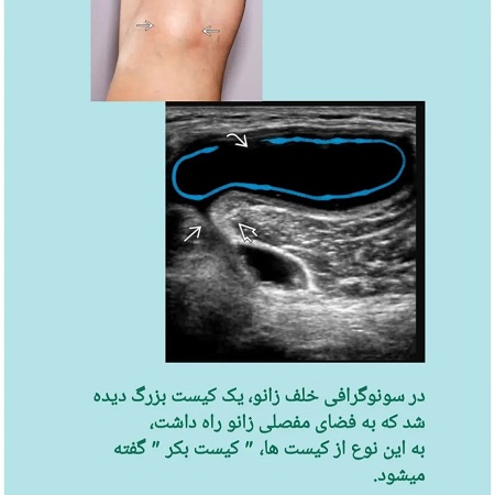 درد زانو با معرفی یک بیمار | کلینیک مغز و اعصاب اصفهان