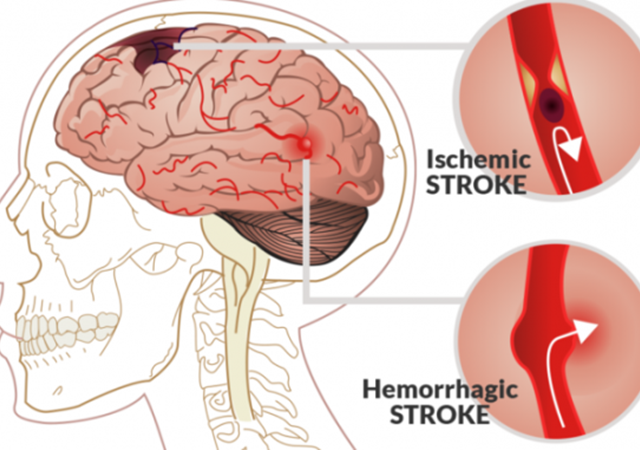 همه چیز در مورد سکته هموراژیک مغز