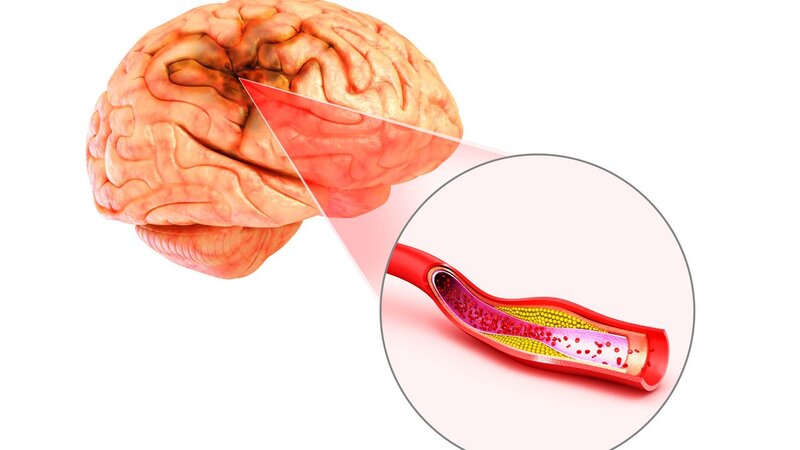 علائم بیماری گرفتگی عروق مغز