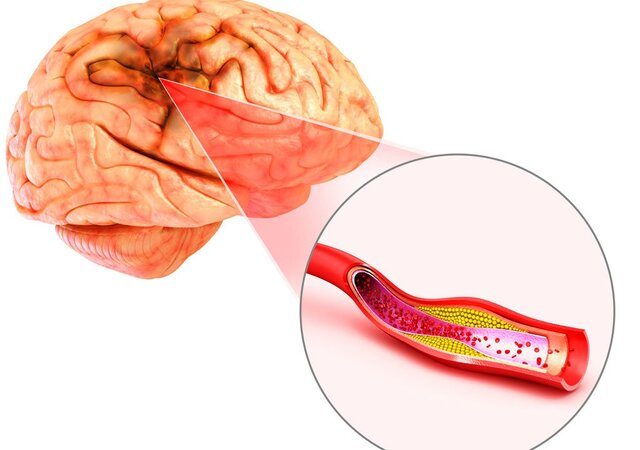 علائم بیماری گرفتگی عروق مغز