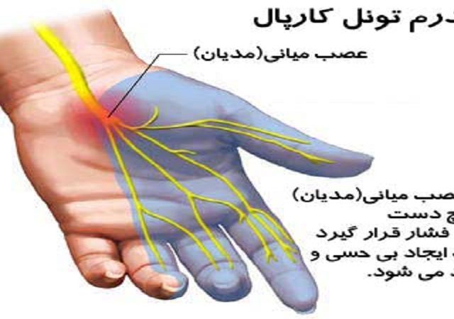 سندرم تونل کارپ | کلینیک مغز و اعصاب اصفهان