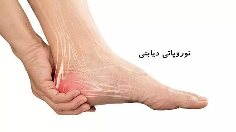 نوروپاتی دیابتی | کلینیک مغز و اعصاب اصفهان | کلینیک تخصصی مغز و اعصاب نورون