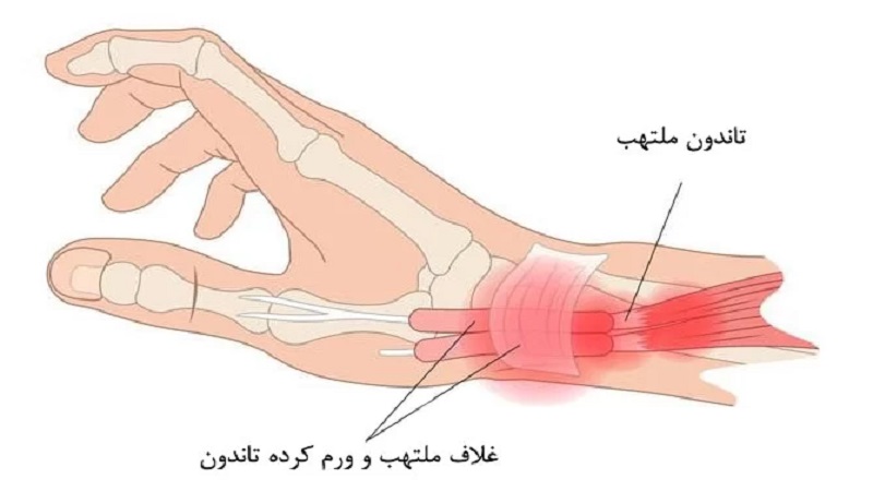 التهاب غلاف تاندونهای ساعد | کلینیک مغز و اعصاب اصفهان | کلینیک تخصصی مغز و اعصاب نورون