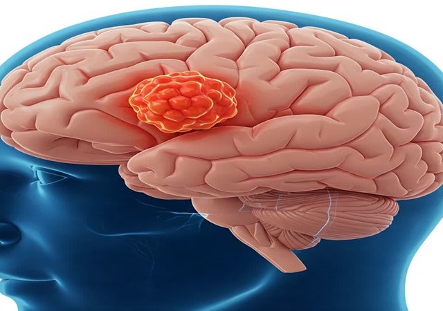 تومورهای مغزی | کلینیک مغز و اعصاب اصفهان | کلینیک تخصصی مغز و اعصاب نورون |بهترین کلینیک مغز و اعصاب اصفهان