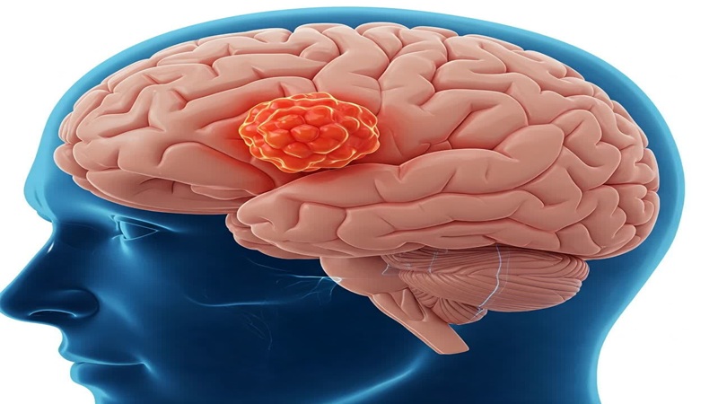 تومورهای مغزی | کلینیک مغز و اعصاب اصفهان | کلینیک تخصصی مغز و اعصاب نورون |بهترین کلینیک مغز و اعصاب اصفهان