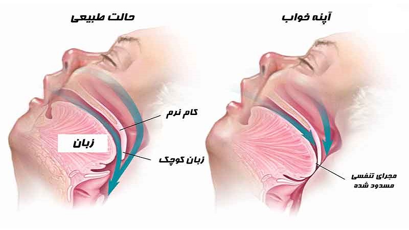 آپنه خواب |کلینیک مغز و اعصاب اصفهان | کلینیک تخصصی مغز و اعصاب نورون |بهترین کلینیک مغز و اعصاب اصفهان